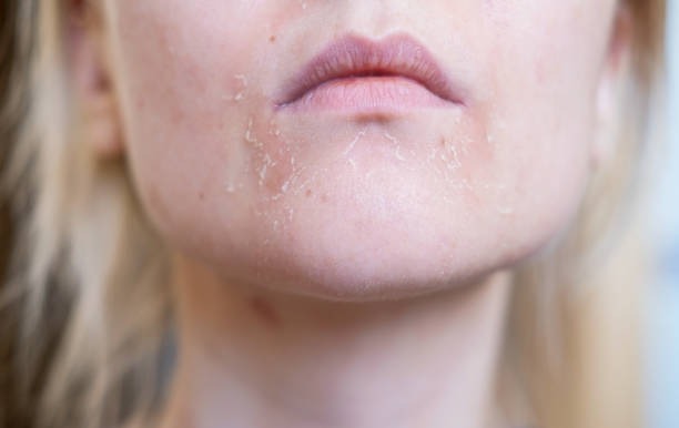 How Stress Triggers Skin Breakouts and Ways to Prevent Them